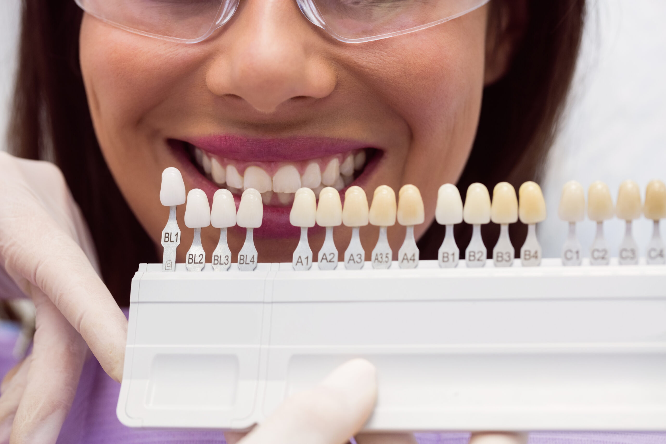 Are Veneers a Permanent Solution for Your Smile?